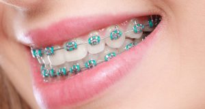 Transforming Smiles with Braces in Stoke-on-Trent: What to Expect