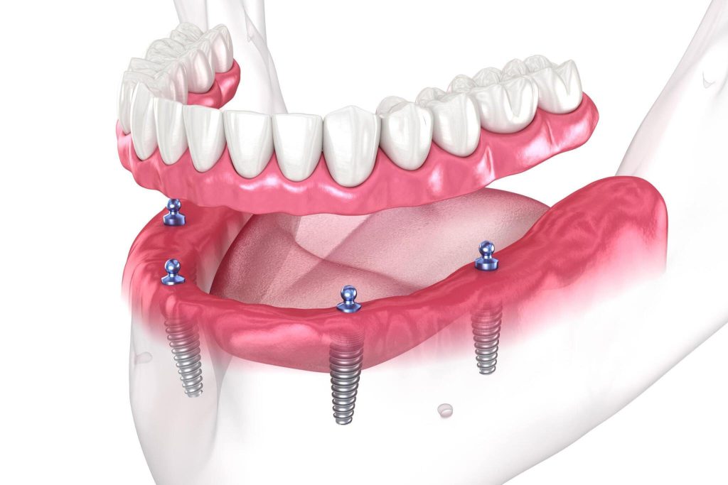 Exploring the Advantages of Modern Dental Implants in Manchester