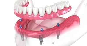 Exploring the Advantages of Modern Dental Implants in Manchester