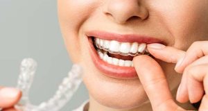 Invisalign Sydney