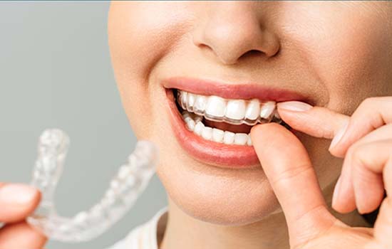 Invisalign Sydney
